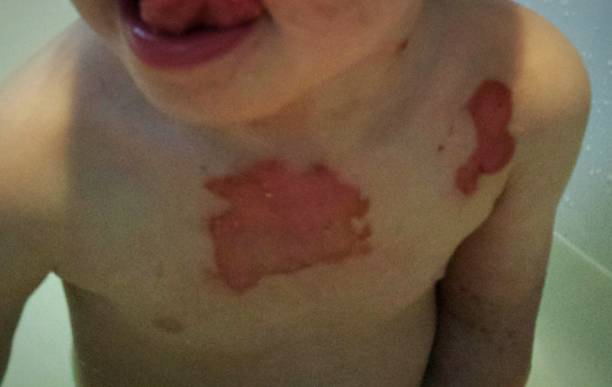 ferite da ustione di secondo grado su un torace del bambino - wound sunburned scar physical injury foto e immagini stock