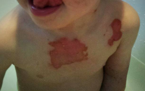 istock Second degree burn wounds on a toddler chest 903206226
