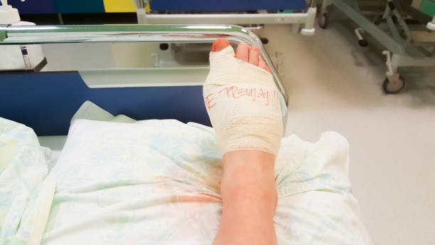 operazione bunion - human foot bunion pain human toe foto e immagini stock