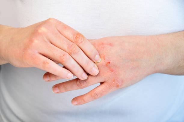 checking the hand Woman checking the hand with very dry skin and deep cracks dermatitis photos stock pictures, royalty-free photos & images