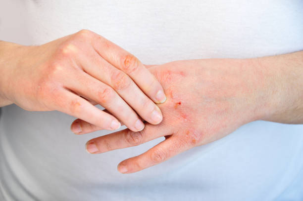 checking the hand Woman checking the hand with very dry skin and deep cracks dry stock pictures, royalty-free photos & images