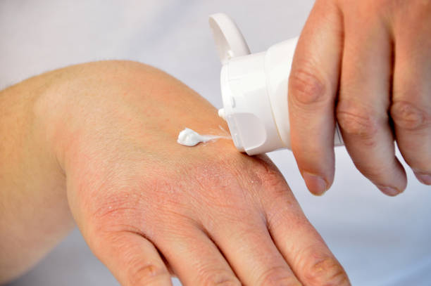 the putting moisturizer Cropped image of a young woman putting moisturizer onto her hand with very dry skin and deep cracks with cream. crevice photos stock pictures, royalty-free photos & images