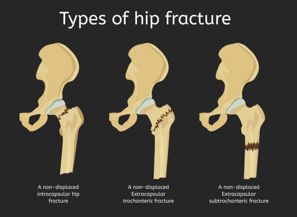 골절의 종류 - fracture stock illustrations