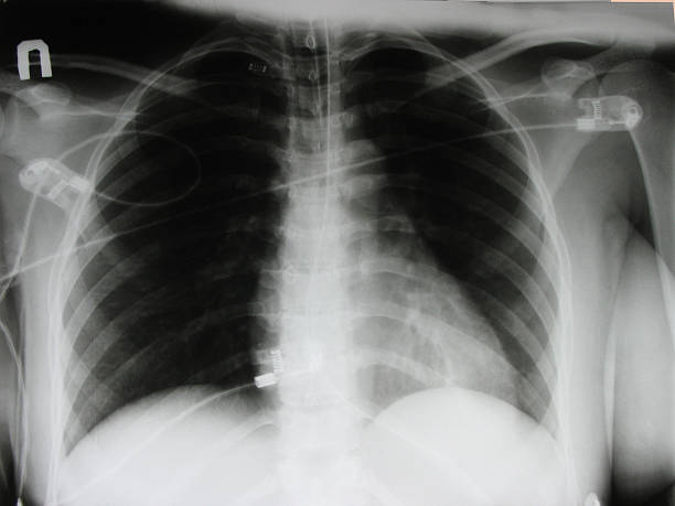 istock XRAY OF A CHEST 90371062
