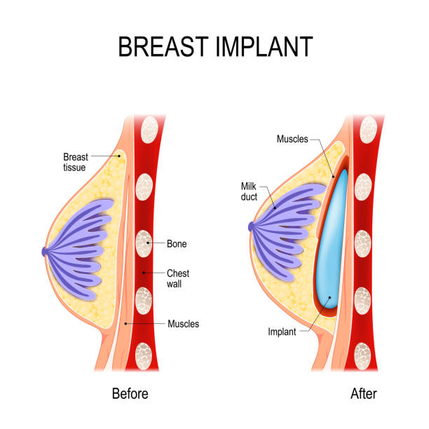 Breast Implant. Cosmetic (plastic) surgery Breast Implant. Cosmetic (plastic) surgery. method of the Submuscular Pocket (under the muscle). This method is used in women who have minimal breast tissue silicone implants stock illustrations