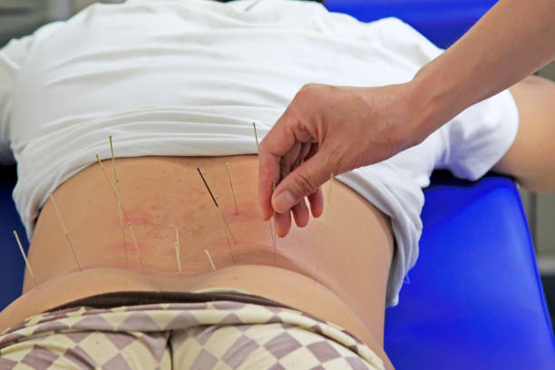 istock Chinese acupuncture and moxibustion, a kind of treatment method 904007162