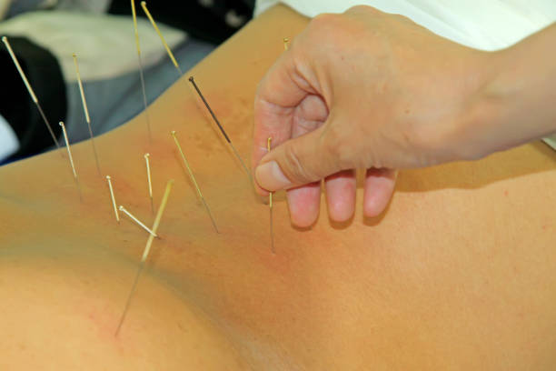 istock Chinese acupuncture and moxibustion, a kind of treatment method 904008418