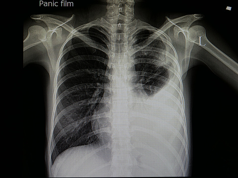 película de rayos x de paciente con neumonía photo