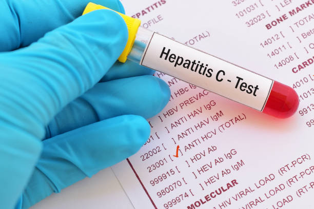 Hepatitis C virus (HCV) test stock photo