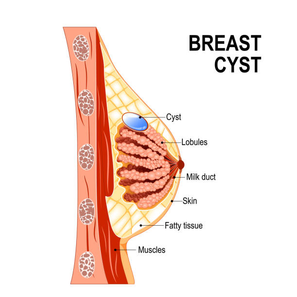 illustrations, cliparts, dessins animés et icônes de kyste mammaire. santé des femmes. - lactiferous duct