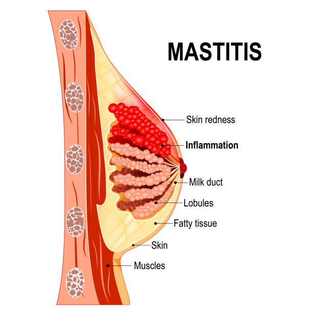 illustrazioni stock, clip art, cartoni animati e icone di tendenza di mastite. sezione trasversale della ghiandola mammaria con infiammazione del seno - lactiferous duct