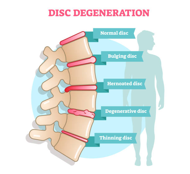 Disc degeneration flat illustration vector diagram with condition exampes - bulging, hernoated, degenerative and thinning disc. Disc degeneration flat illustration vector diagram with condition exampes - bulging, hernoated, degenerative and thinning disc. Educational medical information. full stock illustrations