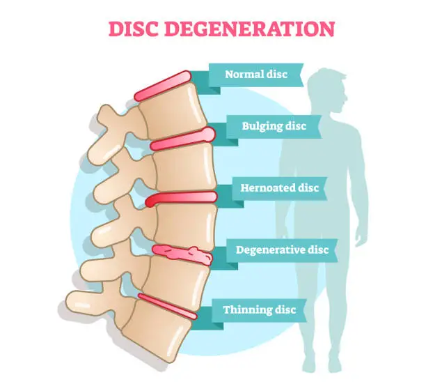 Vector illustration of Disc degeneration flat illustration vector diagram with condition exampes - bulging, hernoated, degenerative and thinning disc.