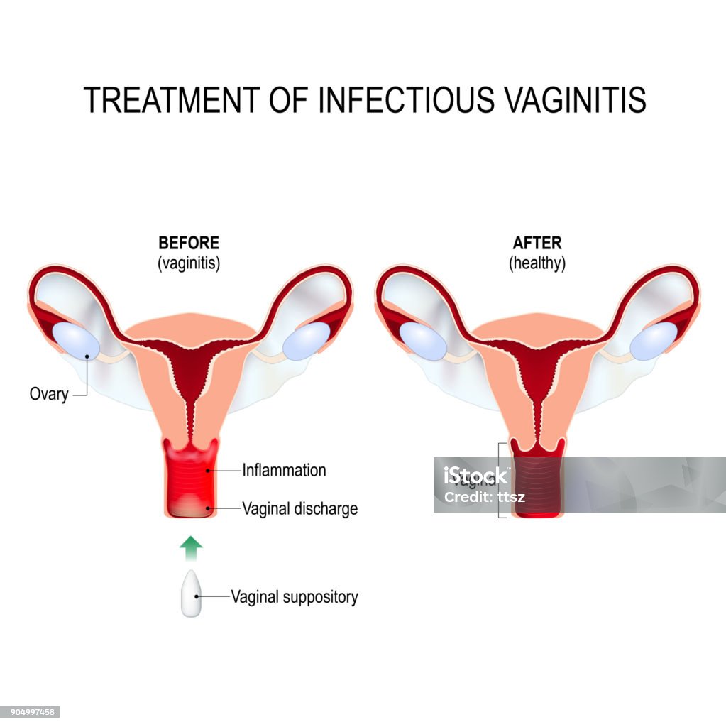 Treatment of infectious vaginitis. Treatment of infectious vaginitis. Cross-section of the uterus with vaginal infection, and healthy womb. inflammation of the vagina. Women's Health. Human anatomy. Vector diagram for medical use Vagina stock vector