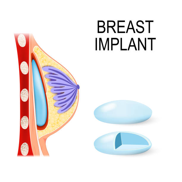 ilustrações, clipart, desenhos animados e ícones de implante mamário - silicone