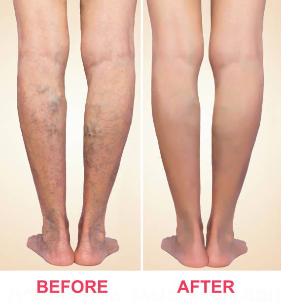 Treatment of varicose before and after. Varicose veins on the legs. Treatment of varicose before and after. Varicose veins on the senior female legs. varicose vein stock pictures, royalty-free photos & images