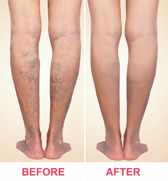 treatment of varicose before and after. varicose veins on the legs. - medicine cabinet medicine healthcare and medicine cabinet imagens e fotografias de stock