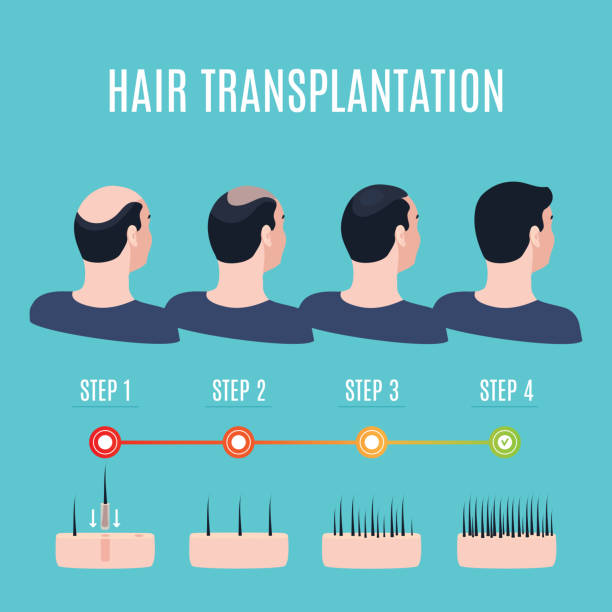 ilustrações, clipart, desenhos animados e ícones de estágios de cirurgia de transplante de cabelo - alopecia homem