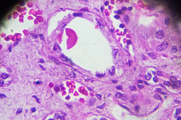 istock Kidney proximal tubule epithelial cloudy SWELLING 905375926