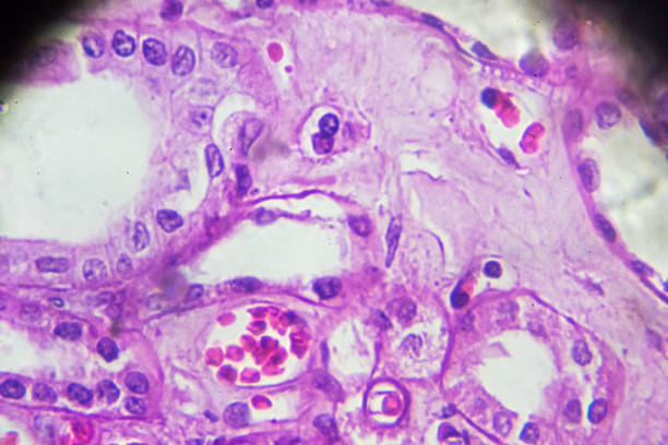 istock Kidney proximal tubule epithelial cloudy SWELLING 905376342