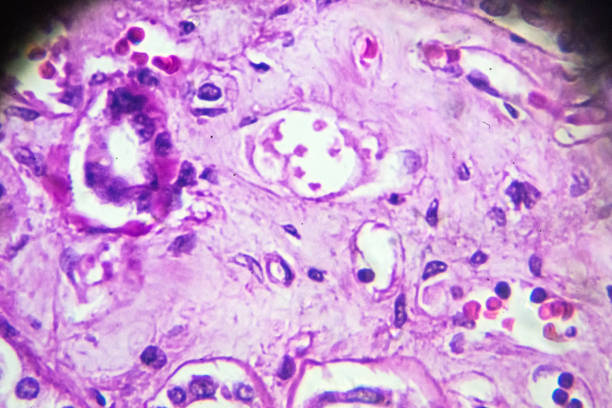 istock Kidney proximal tubule epithelial cloudy SWELLING 905376506