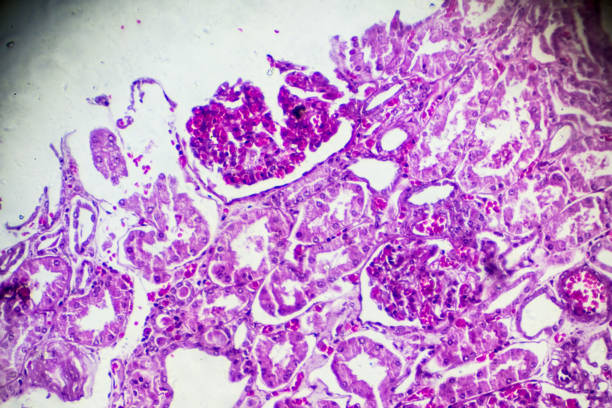 istock Kidney proximal tubule epithelial cloudy SWELLING 905379098