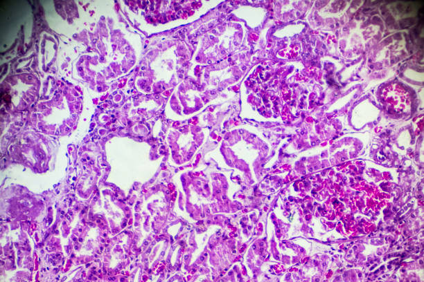 istock Kidney proximal tubule epithelial cloudy SWELLING 905379136