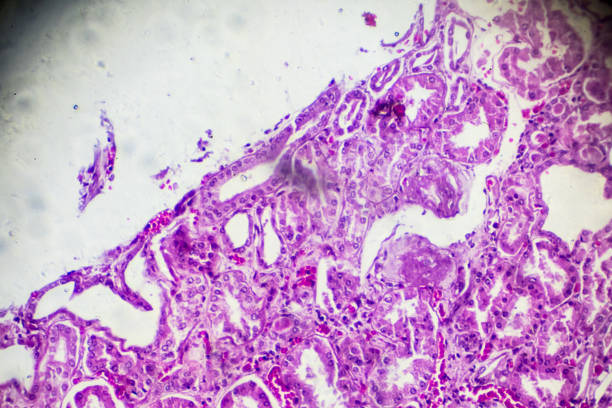 istock Kidney proximal tubule epithelial cloudy SWELLING 905379236