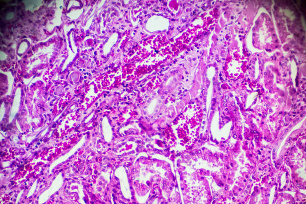 istock Kidney proximal tubule epithelial cloudy SWELLING 905379912
