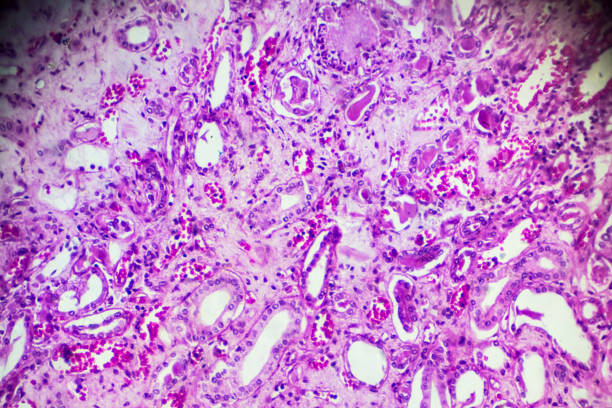 istock Kidney proximal tubule epithelial cloudy SWELLING 905382994