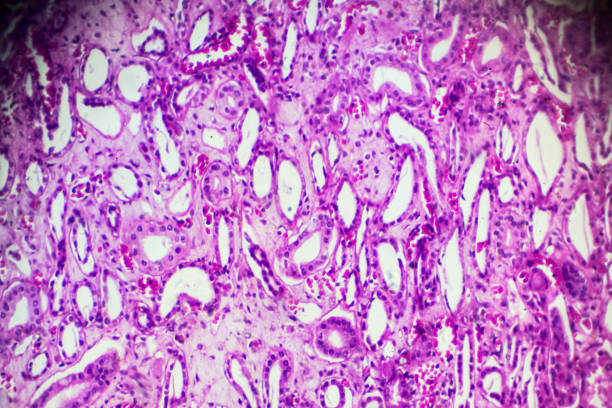 istock Kidney proximal tubule epithelial cloudy SWELLING 905383240