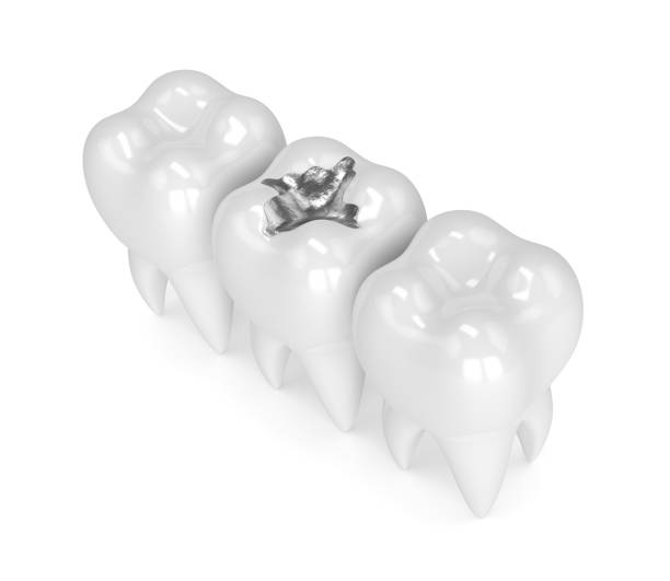 istock 3d render of teeth with dental amalgam filling 905417704