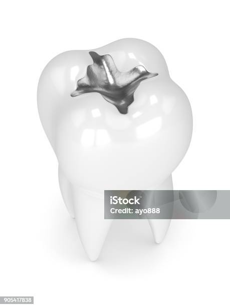 3d Render Of Tooth With Dental Amalgam Filling Stock Photo - Download Image Now - Dental Filling, Alloy, Teeth