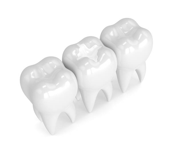 istock 3d render of teeth with dental composite filling 905420130