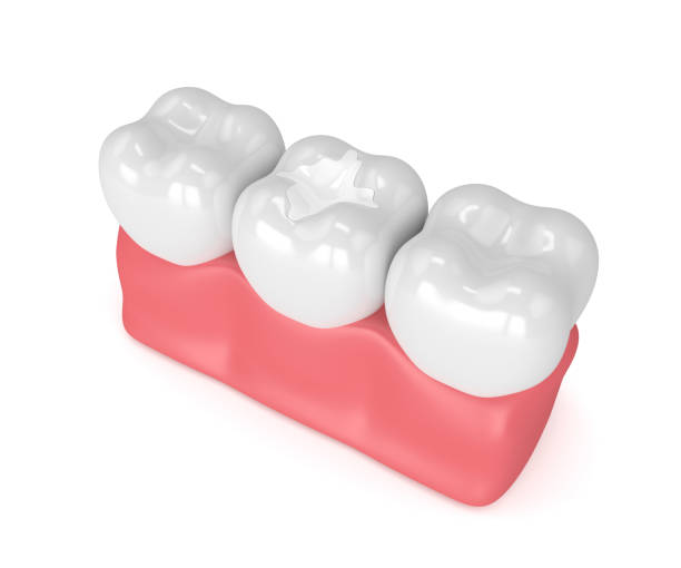 istock 3d render of teeth with dental composite filling 905420514