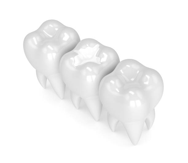 istock 3d render of teeth with dental composite filling 905420666