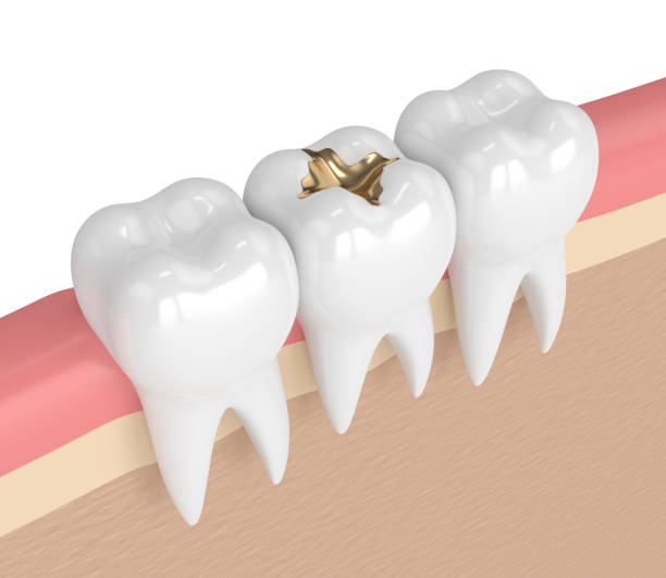 istock 3d render of teeth with dental gold filling 905421200