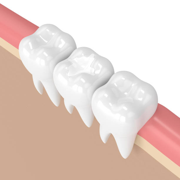 istock 3d render of teeth with dental composite filling 905422300