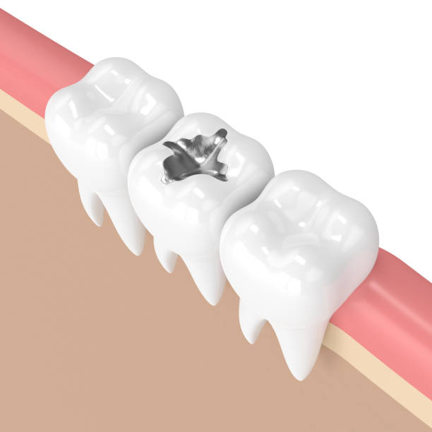 istock 3d render of teeth with dental amalgam filling 905425220
