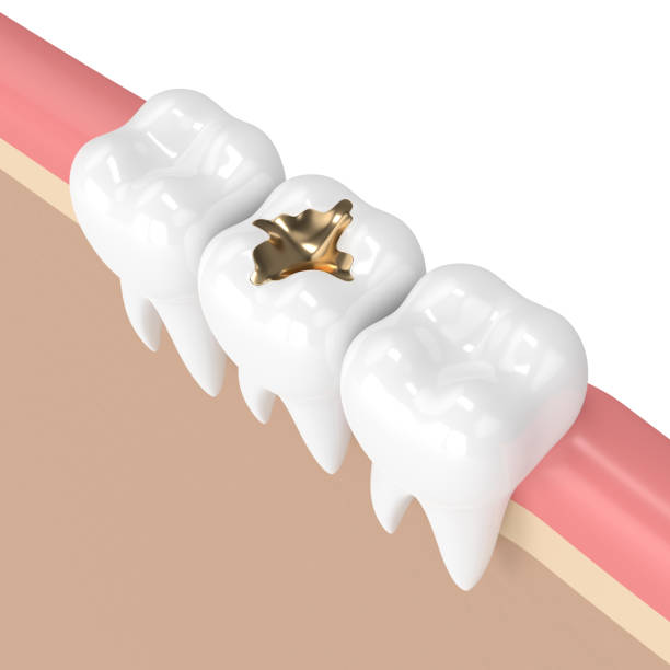 istock 3d render of teeth with dental gold filling 905425650