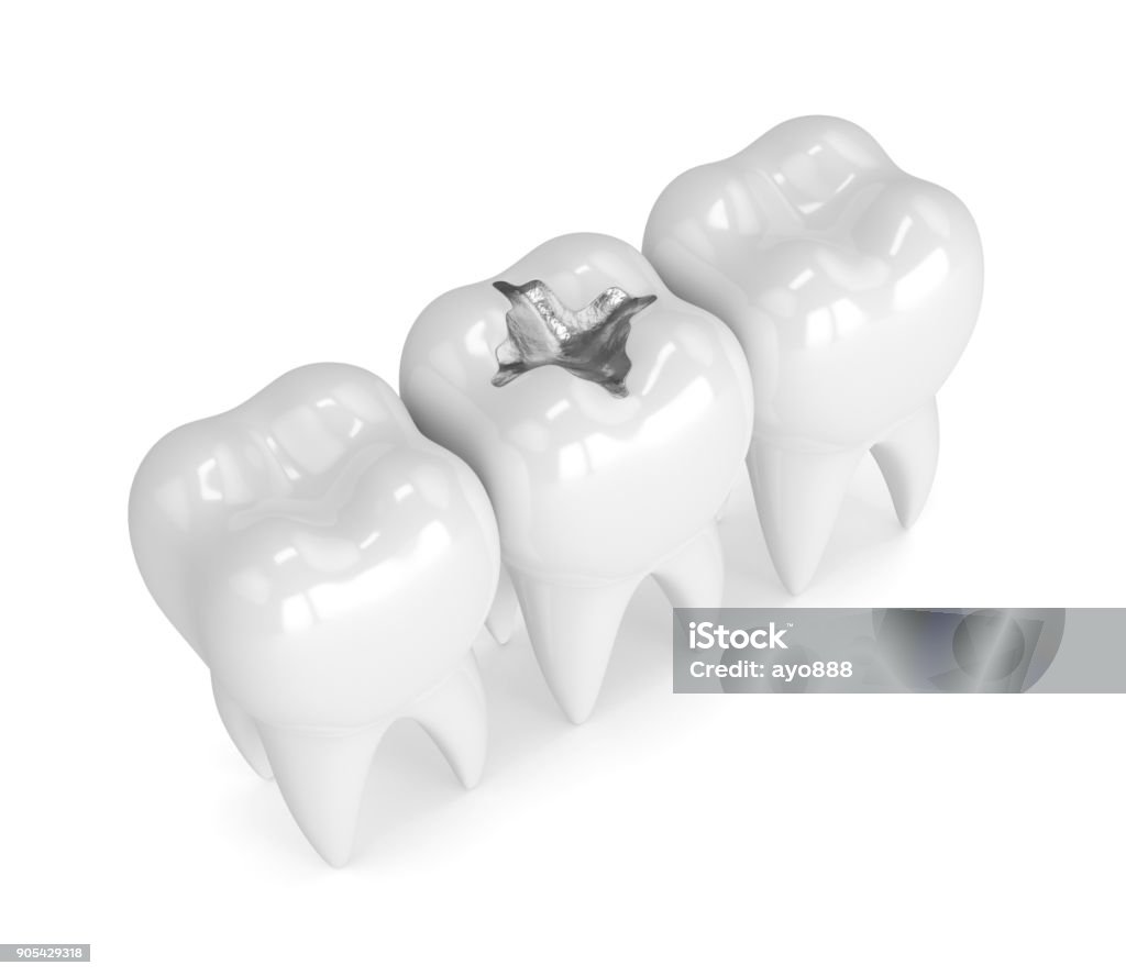 3d render of teeth with dental amalgam filling 3d render of teeth with dental amalgam filling over white background Dental Filling Stock Photo