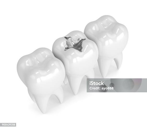 3d Render Of Teeth With Dental Amalgam Filling Stock Photo - Download Image Now - Dental Filling, White Color, Dental Health