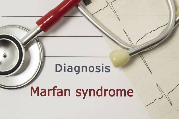 Cardiac diagnosis of Marfan Syndrome. On doctor workplace are red stethoscope, printed on paper ECG line and a pen close up lying on medical handbook, which indicated diagnosis of Marfan Syndrome cardíaco diagnóstico de síndrome de marfan. en el lugar de trabajo médico son estetoscopio rojo, impreso en papel ecg línea y un bolígrafo cerca para arriba la mentira en el manual de médico, que indica el diagnóstico de síndrome de marfan