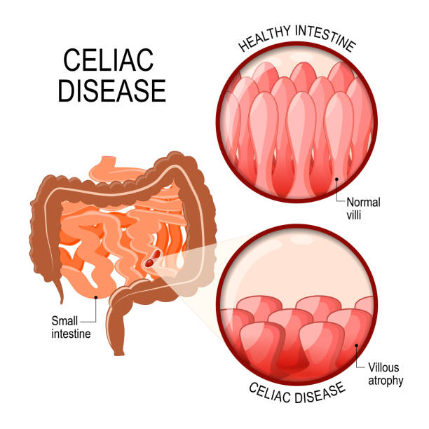 Celiac disease. vector art illustration