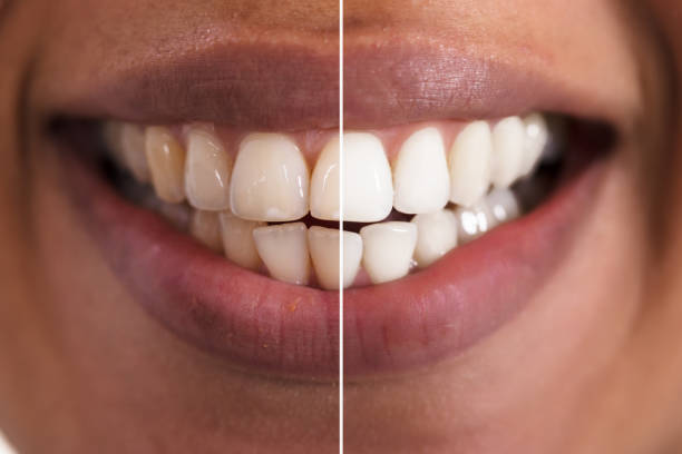 istock Woman Teeth Before And After Whitening 905726976
