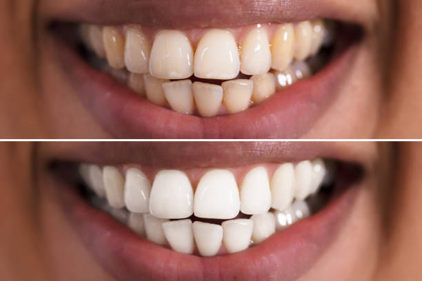 istock Woman Teeth Before And After Whitening 905727000