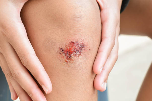 Wound from knee fall Wound from knee fall wound stock pictures, royalty-free photos & images