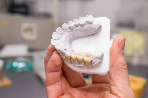 技術的な写真のモデルの歯科 prothetic 研究所 - dental implant dental hygiene dentures prosthetic equipment ストックフォトと画像