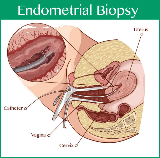 ilustraciones, imágenes clip art, dibujos animados e iconos de stock de ilustración de vector de una biopsia endometrial - espéculo
