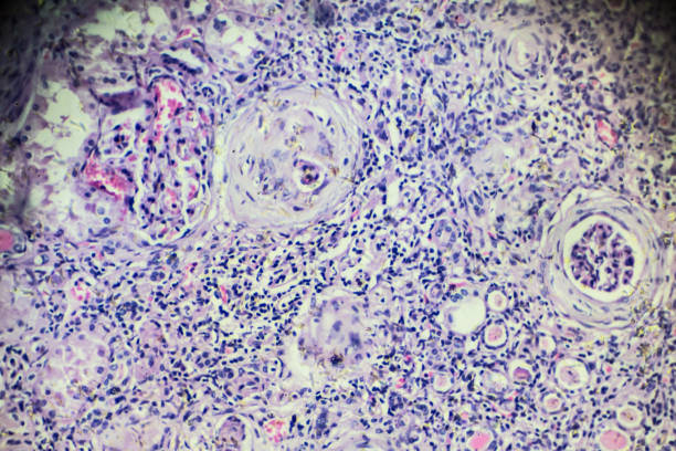 istock Hypertension disease renal different area under microscopy 905869454